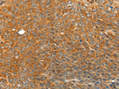 The image on the left is immunohistochemistry of paraffin-embedded Human ovarian cancer tissue using CSB-PA173569(TRIM21 Antibody) at dilution 1/20, on the right is treated with fusion protein. (Original magnification: ×200)