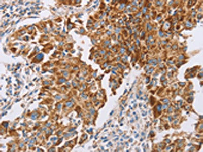 The image on the left is immunohistochemistry of paraffin-embedded Human lung cancer tissue using CSB-PA173685(GUCY1A3 Antibody) at dilution 1/40, on the right is treated with fusion protein. (Original magnification: ×200)