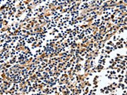 The image on the left is immunohistochemistry of paraffin-embedded Human tonsil tissue using CSB-PA173796(NFKBID Antibody) at dilution 1/25, on the right is treated with fusion protein. (Original magnification: ×200)