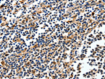The image on the left is immunohistochemistry of paraffin-embedded Human tonsil tissue using CSB-PA173796(NFKBID Antibody) at dilution 1/25, on the right is treated with fusion protein. (Original magnification: ×200)