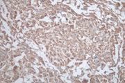 Immunohistochemistry of paraffin-embedded human colon cancer using CSB-PA17384A0Rb at dilution of 1: 100