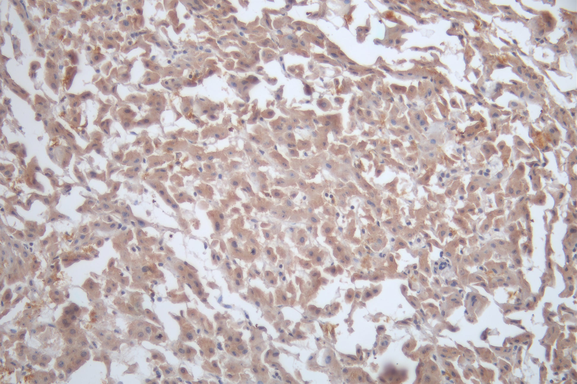Immunohistochemistry of paraffin-embedded human colon cancer using CSB-PA17384A0Rb at dilution of 1: 100