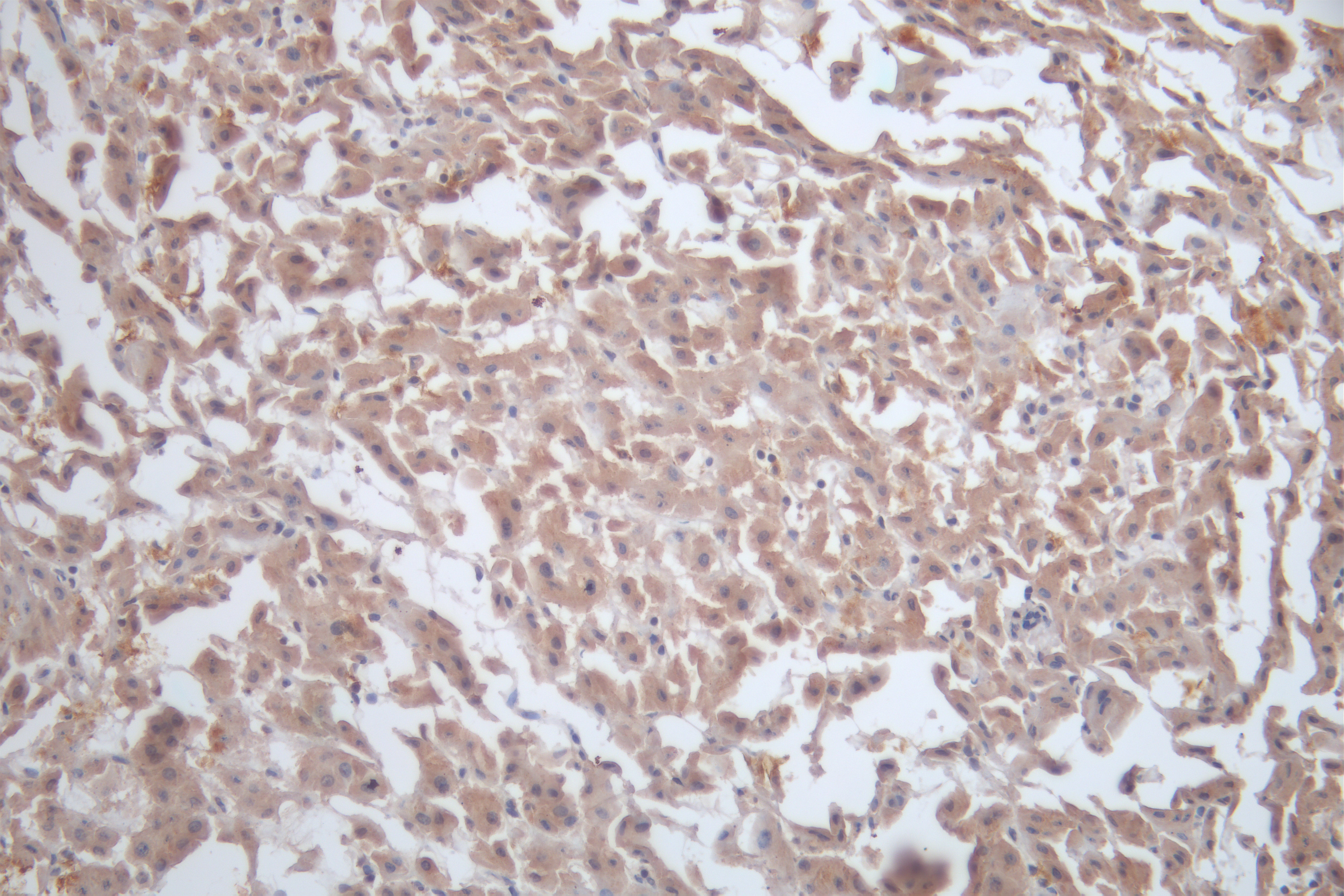 Immunohistochemistry of paraffin-embedded human colon cancer using CSB-PA17384A0Rb at dilution of 1: 100