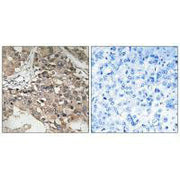 Immunohistochemistry analysis of paraffin-embedded human breast carcinoma tissue using MAP3K7 (Ab-187) antibody.