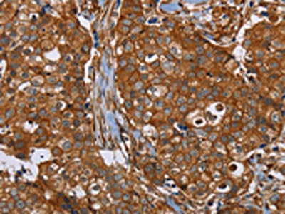 The image on the left is immunohistochemistry of paraffin-embedded Human breast cancer tissue using CSB-PA174144(PLEC Antibody) at dilution 1/40, on the right is treated with synthetic peptide. (Original magnification: ×200)