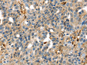The image on the left is immunohistochemistry of paraffin-embedded Human breast cancer tissue using CSB-PA174388(SERPINB6 Antibody) at dilution 1/35, on the right is treated with fusion protein. (Original magnification: ×200)
