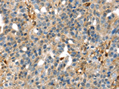 The image on the left is immunohistochemistry of paraffin-embedded Human breast cancer tissue using CSB-PA174388(SERPINB6 Antibody) at dilution 1/35, on the right is treated with fusion protein. (Original magnification: ×200)