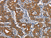 The image on the left is immunohistochemistry of paraffin-embedded Human gastic cancer tissue using CSB-PA174401(CDC23 Antibody) at dilution 1/50, on the right is treated with synthetic peptide. (Original magnification: ×200)