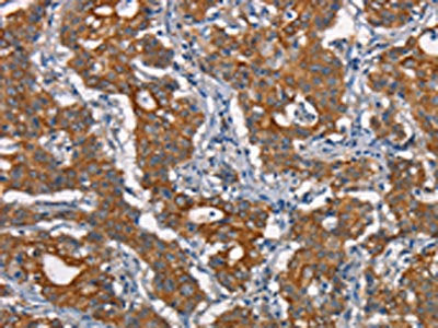 The image on the left is immunohistochemistry of paraffin-embedded Human gastic cancer tissue using CSB-PA174401(CDC23 Antibody) at dilution 1/50, on the right is treated with synthetic peptide. (Original magnification: ×200)