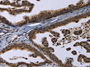 The image on the left is immunohistochemistry of paraffin-embedded Human gastic cancer tissue using CSB-PA174492(REG3A Antibody) at dilution 1/20, on the right is treated with synthetic peptide. (Original magnification: ×200)