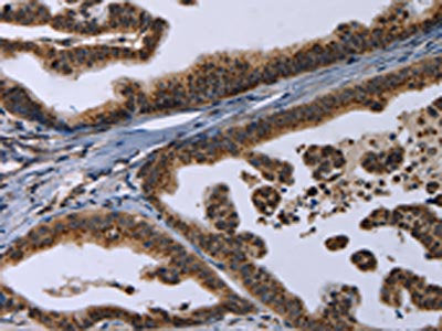The image on the left is immunohistochemistry of paraffin-embedded Human gastic cancer tissue using CSB-PA174492(REG3A Antibody) at dilution 1/20, on the right is treated with synthetic peptide. (Original magnification: ×200)
