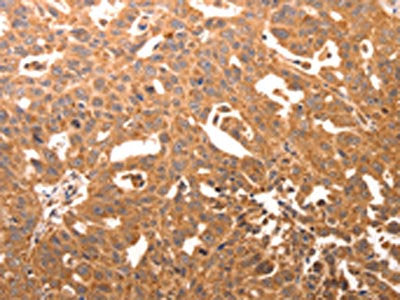 The image on the left is immunohistochemistry of paraffin-embedded Human ovarian cancer tissue using CSB-PA174494(CCL17 Antibody) at dilution 1/60, on the right is treated with synthetic peptide. (Original magnification: ×200)
