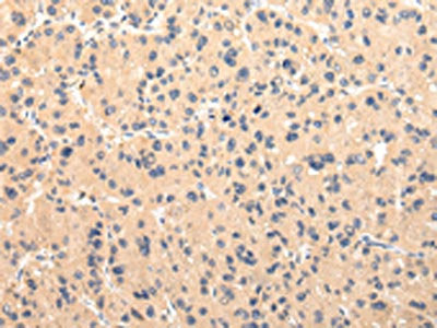 The image on the left is immunohistochemistry of paraffin-embedded Human liver cancer tissue using CSB-PA174496(CMKLR1 Antibody) at dilution 1/30, on the right is treated with synthetic peptide. (Original magnification: ×200)