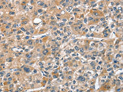 The image on the left is immunohistochemistry of paraffin-embedded Human liver cancer tissue using CSB-PA174578(CHMP4B Antibody) at dilution 1/40, on the right is treated with fusion protein. (Original magnification: ×200)