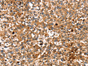 The image on the left is immunohistochemistry of paraffin-embedded Human lung cancer tissue using CSB-PA174690(STAR Antibody) at dilution 1/35, on the right is treated with fusion protein. (Original magnification: ×200)