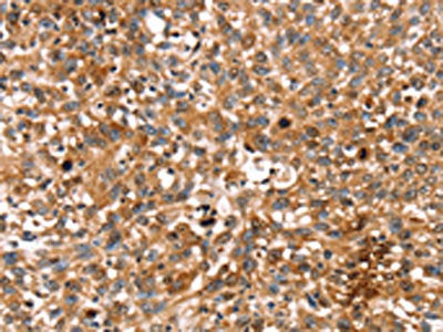 The image on the left is immunohistochemistry of paraffin-embedded Human lung cancer tissue using CSB-PA174690(STAR Antibody) at dilution 1/35, on the right is treated with fusion protein. (Original magnification: ×200)