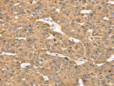 The image on the left is immunohistochemistry of paraffin-embedded Human liver cancer tissue using CSB-PA174716(SMC4 Antibody) at dilution 1/35, on the right is treated with synthetic peptide. (Original magnification: ×200)