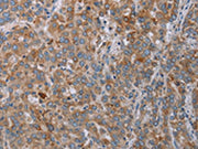 The image on the left is immunohistochemistry of paraffin-embedded Human liver cancer tissue using CSB-PA174726(REG3A Antibody) at dilution 1/20, on the right is treated with synthetic peptide. (Original magnification: ×200)