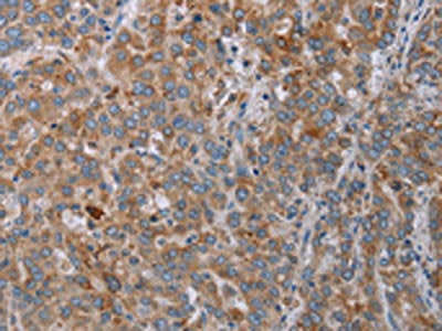 The image on the left is immunohistochemistry of paraffin-embedded Human liver cancer tissue using CSB-PA174726(REG3A Antibody) at dilution 1/20, on the right is treated with synthetic peptide. (Original magnification: ×200)