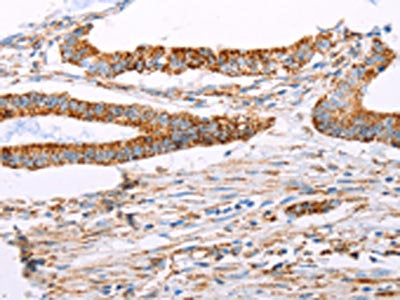 The image on the left is immunohistochemistry of paraffin-embedded Human colon cancer tissue using CSB-PA174758(ATP5J Antibody) at dilution 1/15, on the right is treated with fusion protein. (Original magnification: ×200)