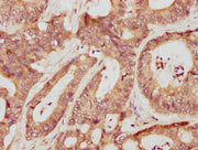 IHC image of CSB-PA17509A0Rb diluted at 1:709 and staining in paraffin-embedded human colon cancer performed on a Leica BondTM system. After dewaxing and hydration, antigen retrieval was mediated by high pressure in a citrate buffer (pH 6.0). Sect...