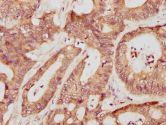 IHC image of CSB-PA17509A0Rb diluted at 1:709 and staining in paraffin-embedded human colon cancer performed on a Leica BondTM system. After dewaxing and hydration, antigen retrieval was mediated by high pressure in a citrate buffer (pH 6.0). Sect...