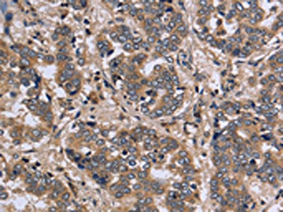The image on the left is immunohistochemistry of paraffin-embedded Human liver cancer tissue using CSB-PA175167(FGL2 Antibody) at dilution 1/20, on the right is treated with fusion protein. (Original magnification: ×200)