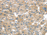 The image on the left is immunohistochemistry of paraffin-embedded Human liver cancer tissue using CSB-PA175261(BRWD1 Antibody) at dilution 1/25, on the right is treated with synthetic peptide. (Original magnification: ×200)
