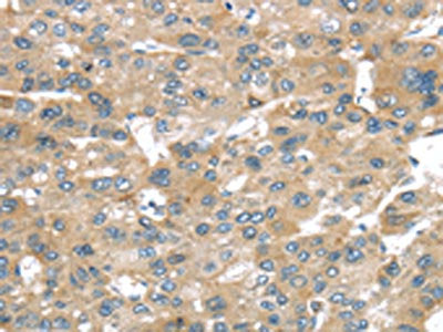The image on the left is immunohistochemistry of paraffin-embedded Human liver cancer tissue using CSB-PA175261(BRWD1 Antibody) at dilution 1/25, on the right is treated with synthetic peptide. (Original magnification: ×200)