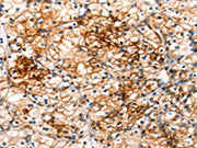 The image on the left is immunohistochemistry of paraffin-embedded Human renal cancer tissue using CSB-PA175313(IRAK2 Antibody) at dilution 1/120, on the right is treated with fusion protein. (Original magnification: ×200)
