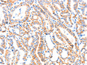 The image on the left is immunohistochemistry of paraffin-embedded Human thyroid cancer tissue using CSB-PA175450(PAFAH2 Antibody) at dilution 1/80, on the right is treated with synthetic peptide. (Original magnification: ×200)