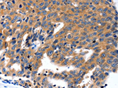The image on the left is immunohistochemistry of paraffin-embedded Human ovarian cancer tissue using CSB-PA175566(KLK5 Antibody) at dilution 1/100, on the right is treated with synthetic peptide. (Original magnification: ×200)
