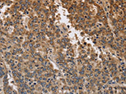 The image on the left is immunohistochemistry of paraffin-embedded Human liver cancer tissue using CSB-PA175630(KCNK9 Antibody) at dilution 1/40, on the right is treated with synthetic peptide. (Original magnification: ×200)