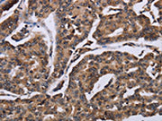 The image on the left is immunohistochemistry of paraffin-embedded Human breast cancer tissue using CSB-PA175695(KIF1C Antibody) at dilution 1/60, on the right is treated with fusion protein. (Original magnification: ×200)