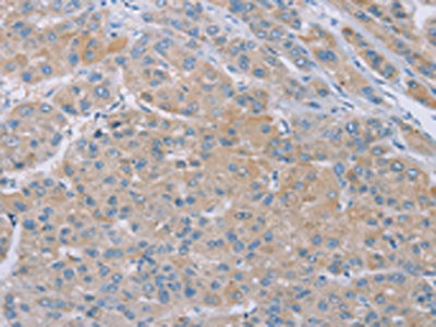 The image on the left is immunohistochemistry of paraffin-embedded Human liver cancer tissue using CSB-PA175876(SAMD4B Antibody) at dilution 1/20, on the right is treated with synthetic peptide. (Original magnification: ×200)