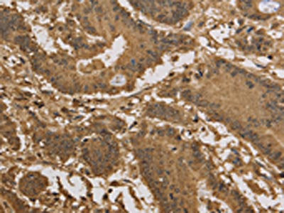 The image on the left is immunohistochemistry of paraffin-embedded Human colon cancer tissue using CSB-PA176057(KDM5B Antibody) at dilution 1/40, on the right is treated with synthetic peptide. (Original magnification: ×200)
