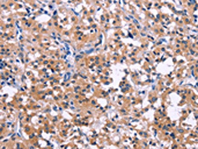 The image on the left is immunohistochemistry of paraffin-embedded Human thyroid cancer tissue using CSB-PA176280(DUSP13 Antibody) at dilution 1/50, on the right is treated with fusion protein. (Original magnification: ×200)