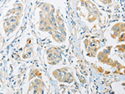 The image on the left is immunohistochemistry of paraffin-embedded Human breast cancer tissue using CSB-PA176345(ARHGEF10 Antibody) at dilution 1/45, on the right is treated with fusion protein. (Original magnification: ×200)