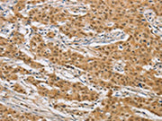 The image on the left is immunohistochemistry of paraffin-embedded Human gastic cancer tissue using CSB-PA176612(ARHGAP25 Antibody) at dilution 1/40, on the right is treated with fusion protein. (Original magnification: ×200)
