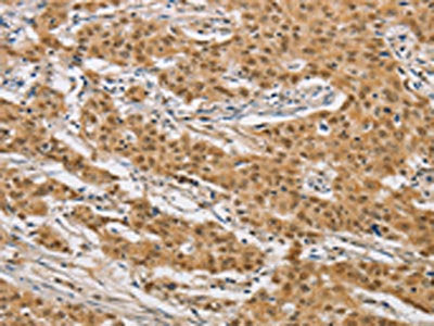 The image on the left is immunohistochemistry of paraffin-embedded Human gastic cancer tissue using CSB-PA176612(ARHGAP25 Antibody) at dilution 1/40, on the right is treated with fusion protein. (Original magnification: ×200)