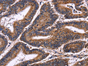 The image on the left is immunohistochemistry of paraffin-embedded Human colon cancer tissue using CSB-PA176639(AMIGO2 Antibody) at dilution 1/50, on the right is treated with fusion protein. (Original magnification: ×200)