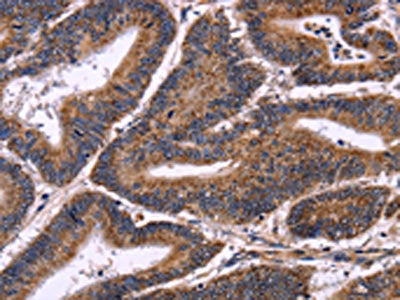 The image on the left is immunohistochemistry of paraffin-embedded Human colon cancer tissue using CSB-PA176639(AMIGO2 Antibody) at dilution 1/50, on the right is treated with fusion protein. (Original magnification: ×200)