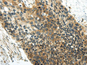 The image on the left is immunohistochemistry of paraffin-embedded Human esophagus cancer tissue using CSB-PA176759(WISP1 Antibody) at dilution 1/25, on the right is treated with synthetic peptide. (Original magnification: ×200)