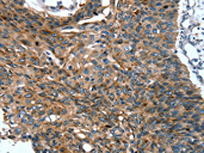 The image on the left is immunohistochemistry of paraffin-embedded Human esophagus cancer tissue using CSB-PA176863(SCPEP1 Antibody) at dilution 1/20, on the right is treated with fusion protein. (Original magnification: ×200)