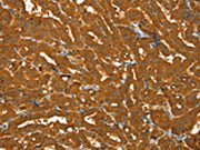 The image on the left is immunohistochemistry of paraffin-embedded Human thyroid cancer tissue using CSB-PA176883(PYGM Antibody) at dilution 1/30, on the right is treated with fusion protein. (Original magnification: ×200)
