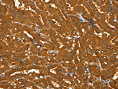 The image on the left is immunohistochemistry of paraffin-embedded Human thyroid cancer tissue using CSB-PA176883(PYGM Antibody) at dilution 1/30, on the right is treated with fusion protein. (Original magnification: ×200)