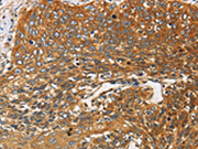The image on the left is immunohistochemistry of paraffin-embedded Human cervical cancer tissue using CSB-PA176976(DCTN2 Antibody) at dilution 1/25, on the right is treated with fusion protein. (Original magnification: ×200)