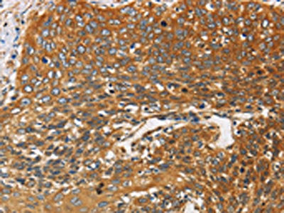 The image on the left is immunohistochemistry of paraffin-embedded Human cervical cancer tissue using CSB-PA176976(DCTN2 Antibody) at dilution 1/25, on the right is treated with fusion protein. (Original magnification: ×200)
