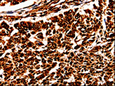 The image is immunohistochemistry of paraffin-embedded Human lung cancer tissue using CSB-PA177370(BOLL Antibody) at dilution 1/10. (Original magnification: ×200)