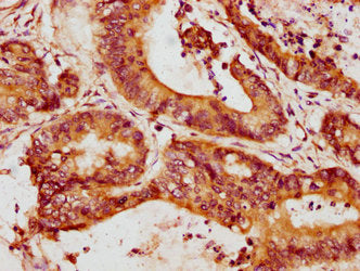 IHC image of CSB-PA17739A0Rb diluted at 1:200 and staining in paraffin-embedded human colon cancer performed on a Leica BondTM system. After dewaxing and hydration, antigen retrieval was mediated by high pressure in a citrate buffer (pH 6.0). Sect...